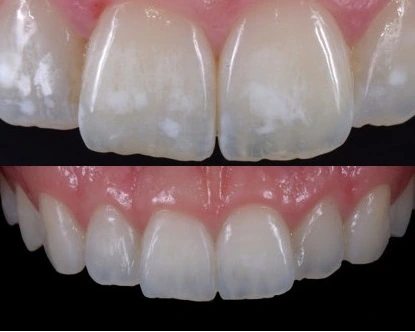 Zähne vor und nach der White Spot Behandlung